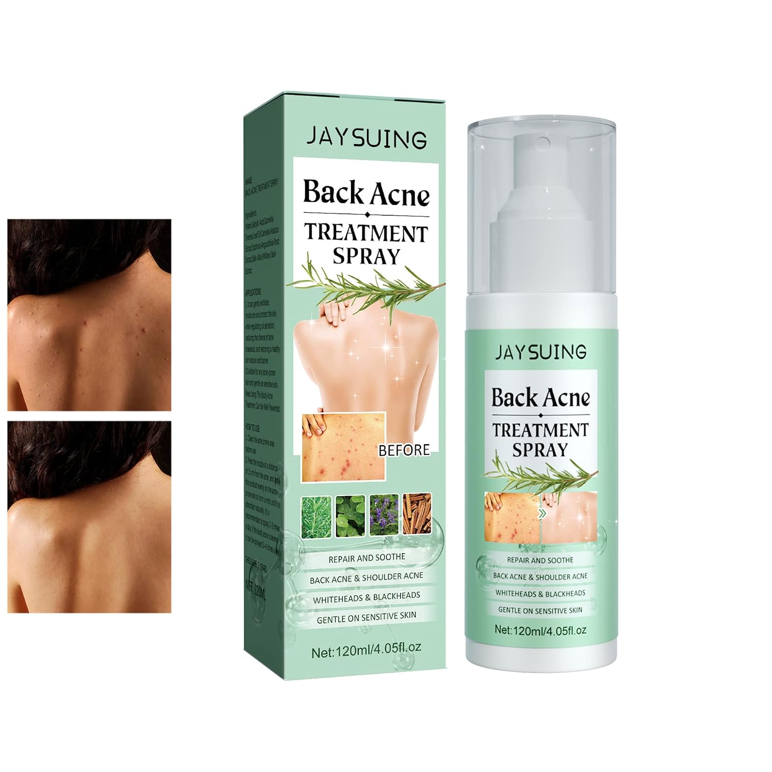 Back Acne Treatment Spray