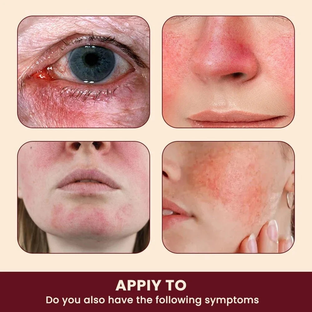 Sumifun - Rosacea Relief Ointment