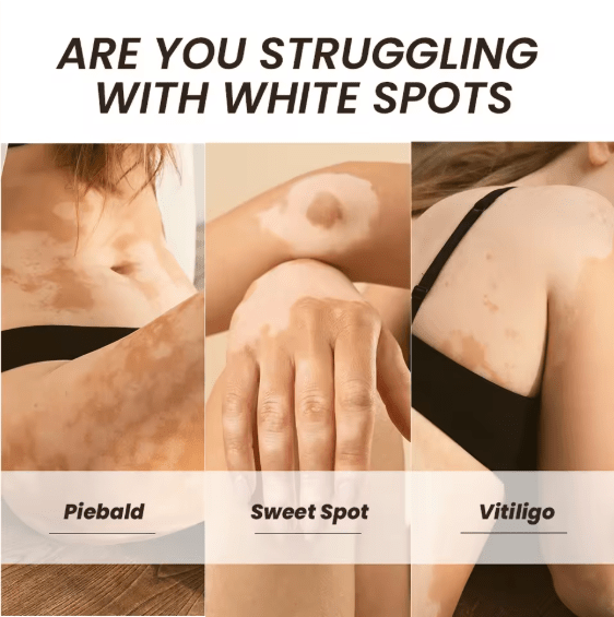 Sumifun - Vitamine Vitiligo Cream