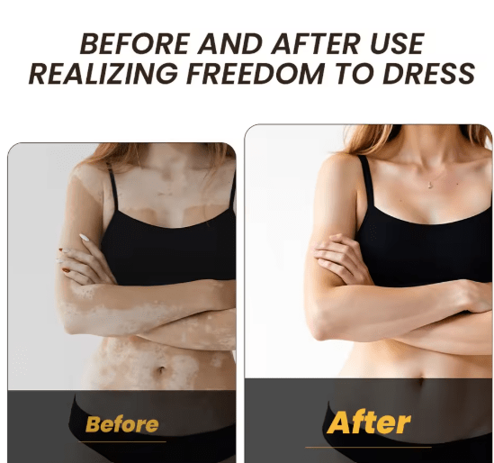 Sumifun - Vitamine Vitiligo Cream